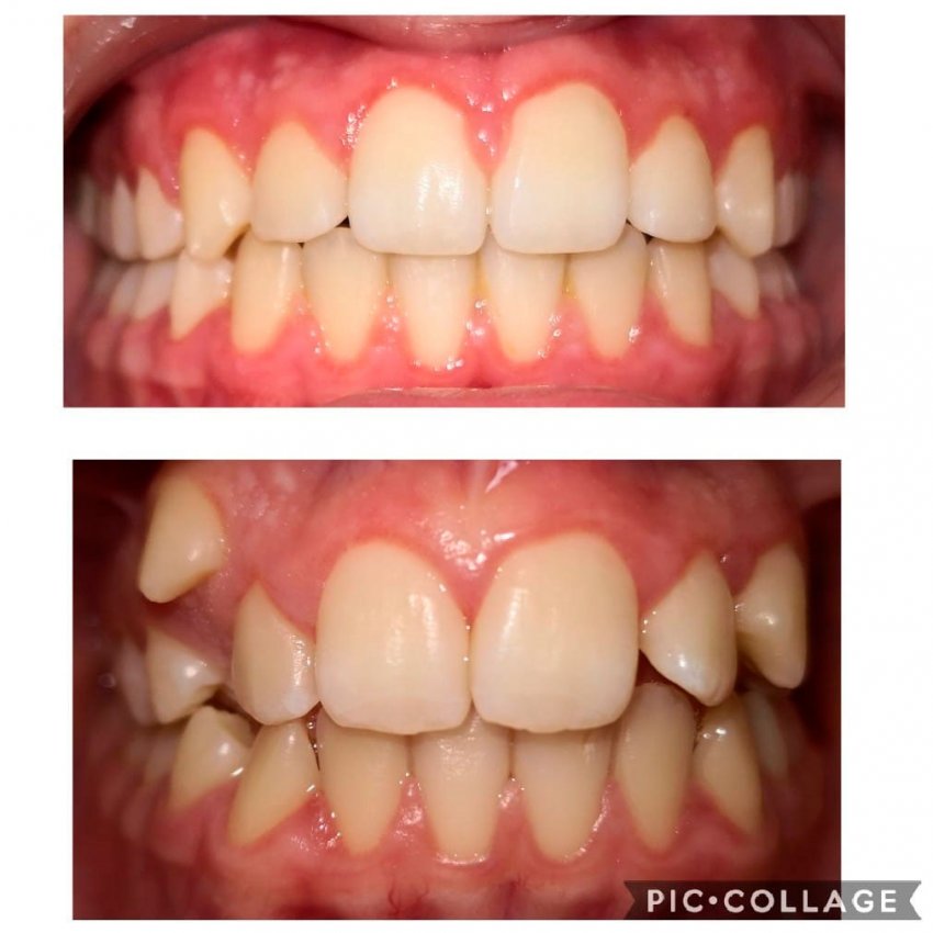 Ortodoncia baja fricción Clínica Dental Dr Hernán Castilla