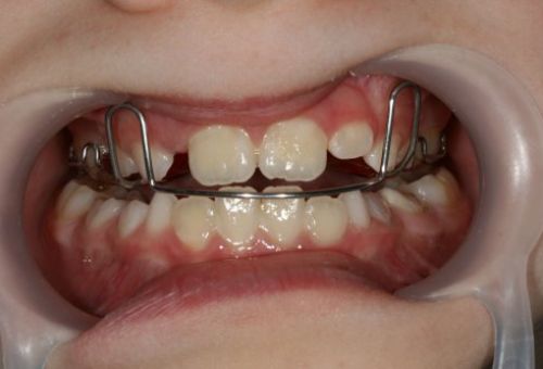 Caso ortopedia y ortodoncia Caso ortopedia y ortodoncia