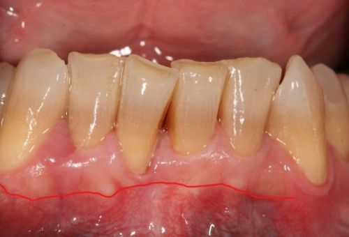 Caso de cirugía periodontal Caso de cirugía periodontal